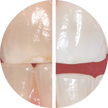 Close-up comparison of teeth before and after whitening treatment
