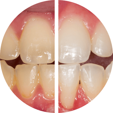 Close-up comparison of teeth before and after whitening treatment
