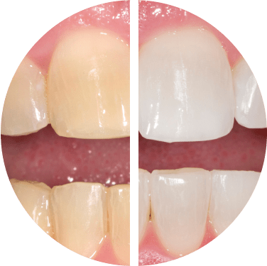 Close-up comparison of teeth before and after whitening treatment