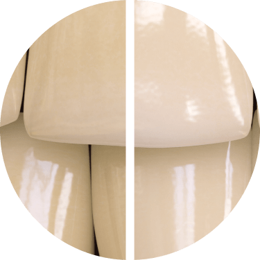 Close-up comparison of teeth before and after whitening treatment