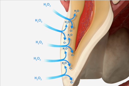 Illustration showing the effects of hydrogen peroxide (H2O2) in a dental treatment process