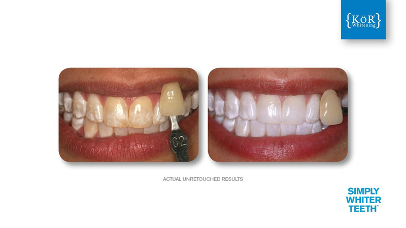Simply Whiter Teeth Before And After Case 1