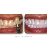Simply Whiter Teeth Before And After Case 1