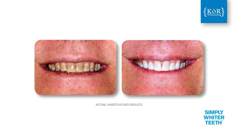 Simply Whiter Teeth Before And After Case 9