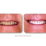 Simply Whiter Teeth Before And After Case 9