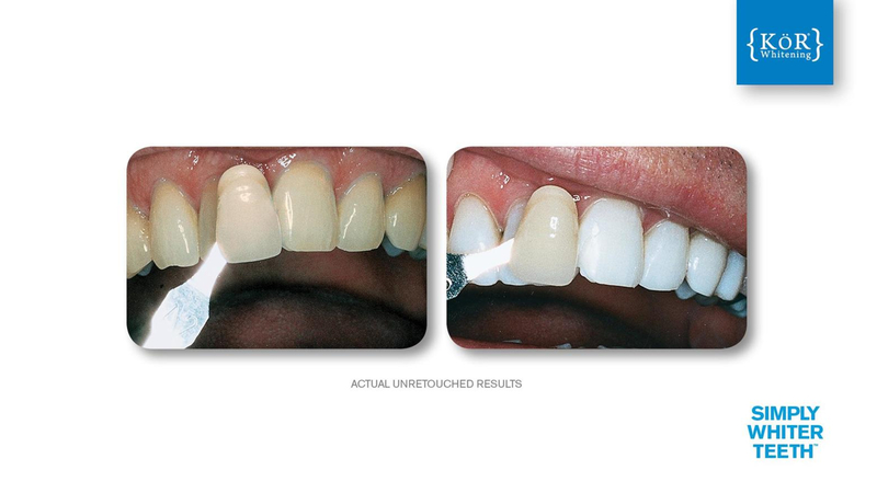 Simply Whiter Teeth Before And After Case 10