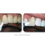 Simply Whiter Teeth Before And After Case 10