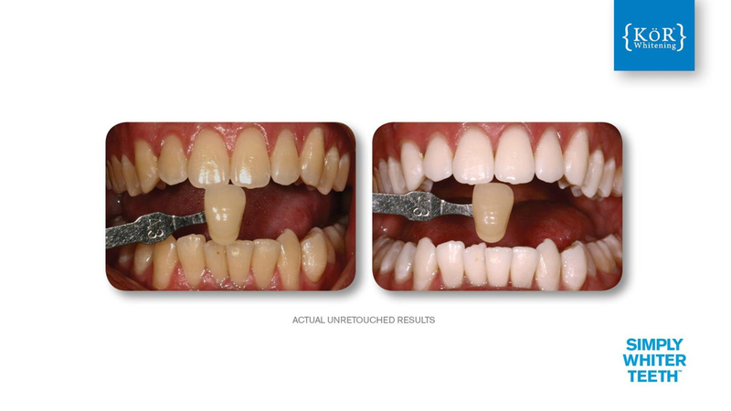 Simply Whiter Teeth Before And After Case 11
