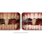 Simply Whiter Teeth Before And After Case 11