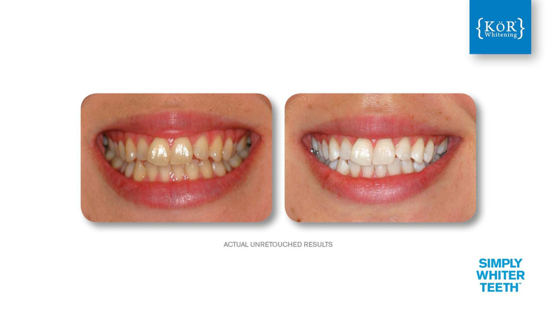 Simply Whiter Teeth Before And After Case 12