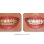 Simply Whiter Teeth Before And After Case 12
