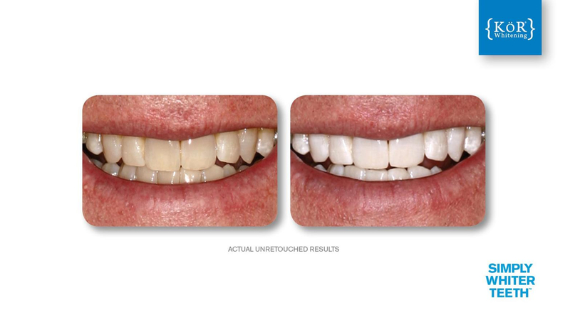 Simply Whiter Teeth Before And After Case 13