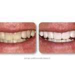 Simply Whiter Teeth Before And After Case 13