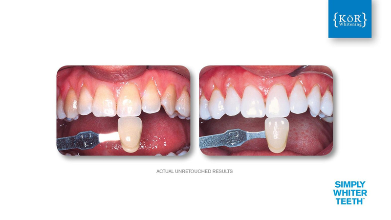 Simply Whiter Teeth Before And After Case 14