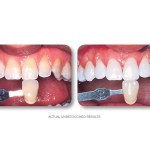Simply Whiter Teeth Before And After Case 14