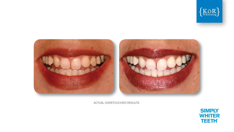 Simply Whiter Teeth Before And After Case 15