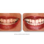 Simply Whiter Teeth Before And After Case 15