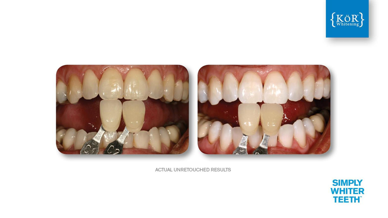 Simply Whiter Teeth Before And After Case 16