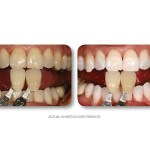 Simply Whiter Teeth Before And After Case 16
