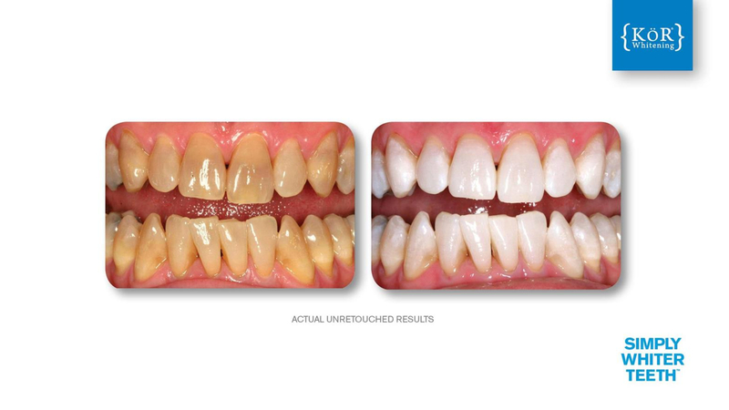 Simply Whiter Teeth Before And After Case 17