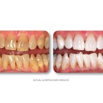 Simply Whiter Teeth Before And After Case 17