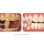 Simply Whiter Teeth Before And After Case 2
