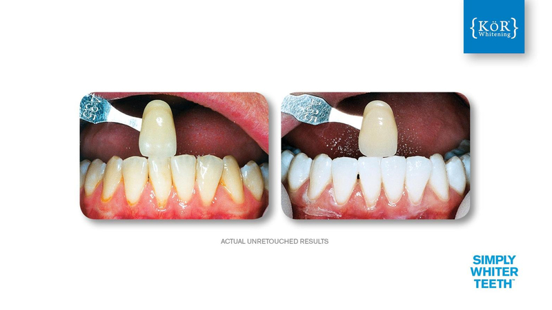 Simply Whiter Teeth Before And After Case 18