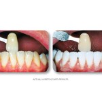 Simply Whiter Teeth Before And After Case 18