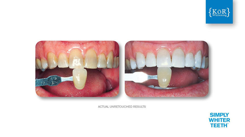 Simply Whiter Teeth Before And After Case 19