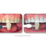 Simply Whiter Teeth Before And After Case 19