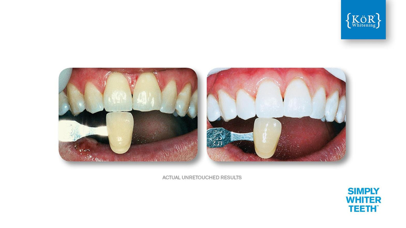 Simply Whiter Teeth Before And After Case 20