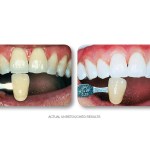 Simply Whiter Teeth Before And After Case 20