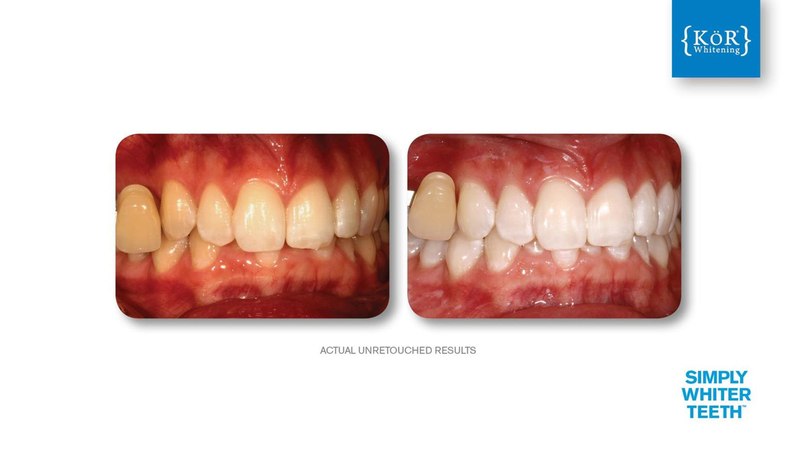 Simply Whiter Teeth Before And After Case 21