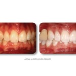 Simply Whiter Teeth Before And After Case 21