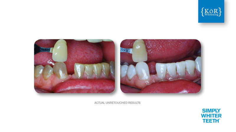 Simply Whiter Teeth Before And After Case 22