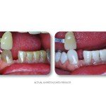 Simply Whiter Teeth Before And After Case 22