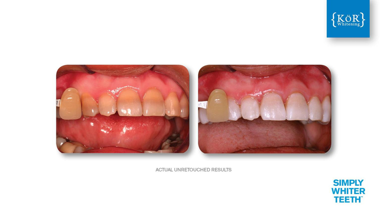 Simply Whiter Teeth Before And After Case 23