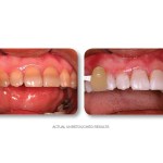 Simply Whiter Teeth Before And After Case 23