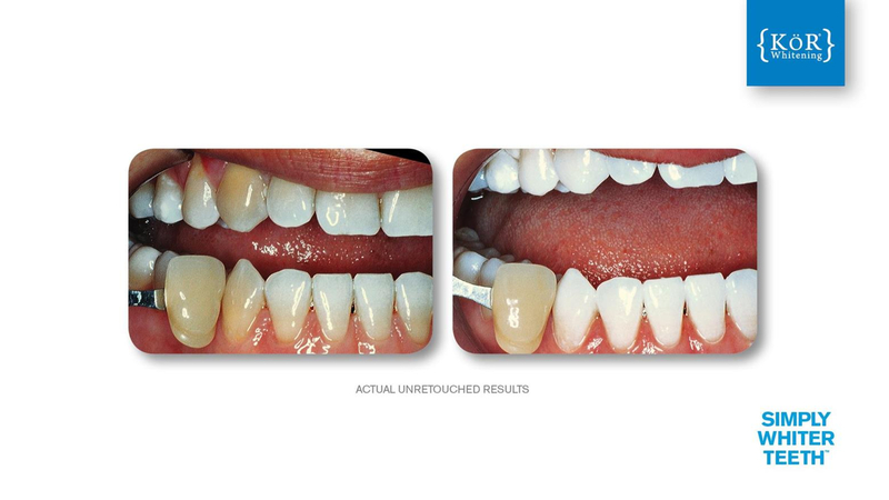 Simply Whiter Teeth Before And After Case 24