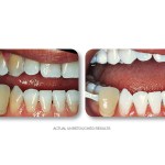 Simply Whiter Teeth Before And After Case 24