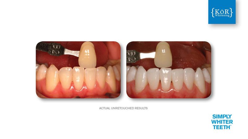 Simply Whiter Teeth Before And After Case 25