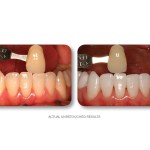 Simply Whiter Teeth Before And After Case 25