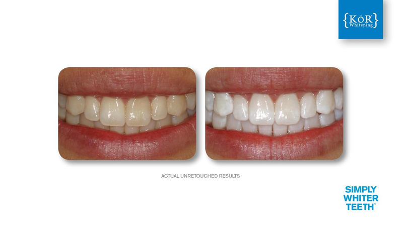 Simply Whiter Teeth Before And After Case 26