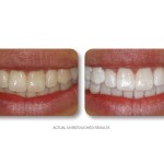 Simply Whiter Teeth Before And After Case 26