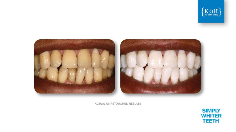 Simply Whiter Teeth Before And After Case 3
