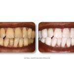 Simply Whiter Teeth Before And After Case 3