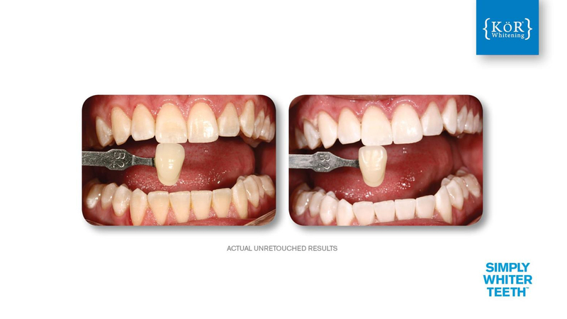 Simply Whiter Teeth Before And After Case 27