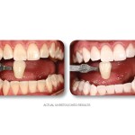 Simply Whiter Teeth Before And After Case 27