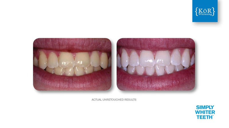 Simply Whiter Teeth Before And After Case 28