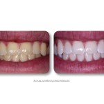 Simply Whiter Teeth Before And After Case 28